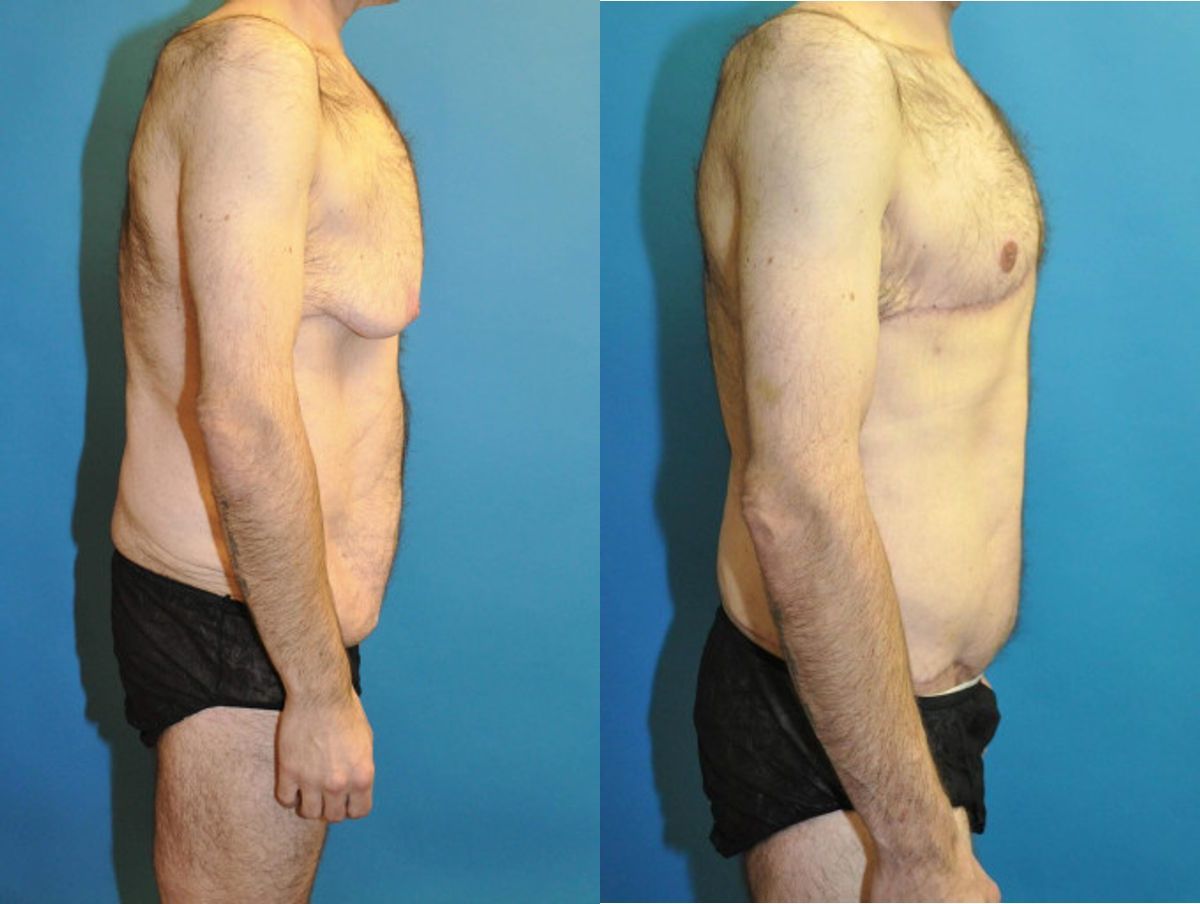 Total Body Lift (Upper and Lower Body Lift) - Before and After