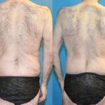 Total Body Lift (Upper and Lower Body Lift) - Before and After