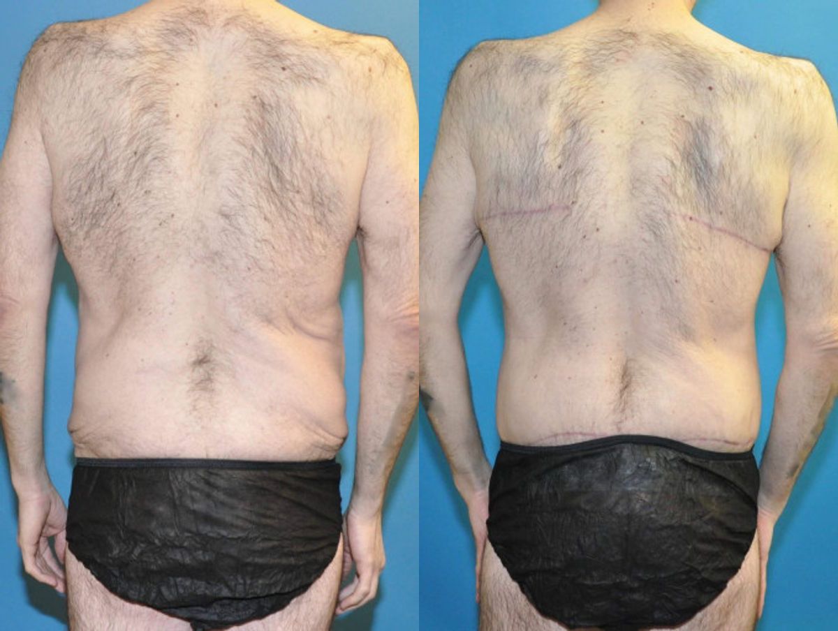 Total Body Lift (Upper and Lower Body Lift) - Before and After