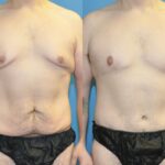 Total Body Lift (Upper and Lower Body Lift)#2 - Before and After