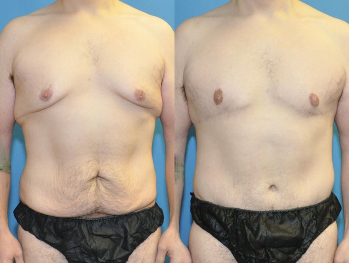 Total Body Lift (Upper and Lower Body Lift)#2 - Before and After