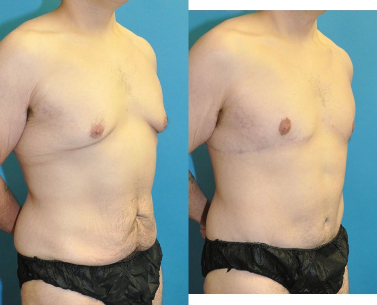 Total Body Lift (Upper and Lower Body Lift)#2 - Before and After