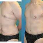 Total Body Lift (Upper and Lower Body Lift)#2 - Before and After
