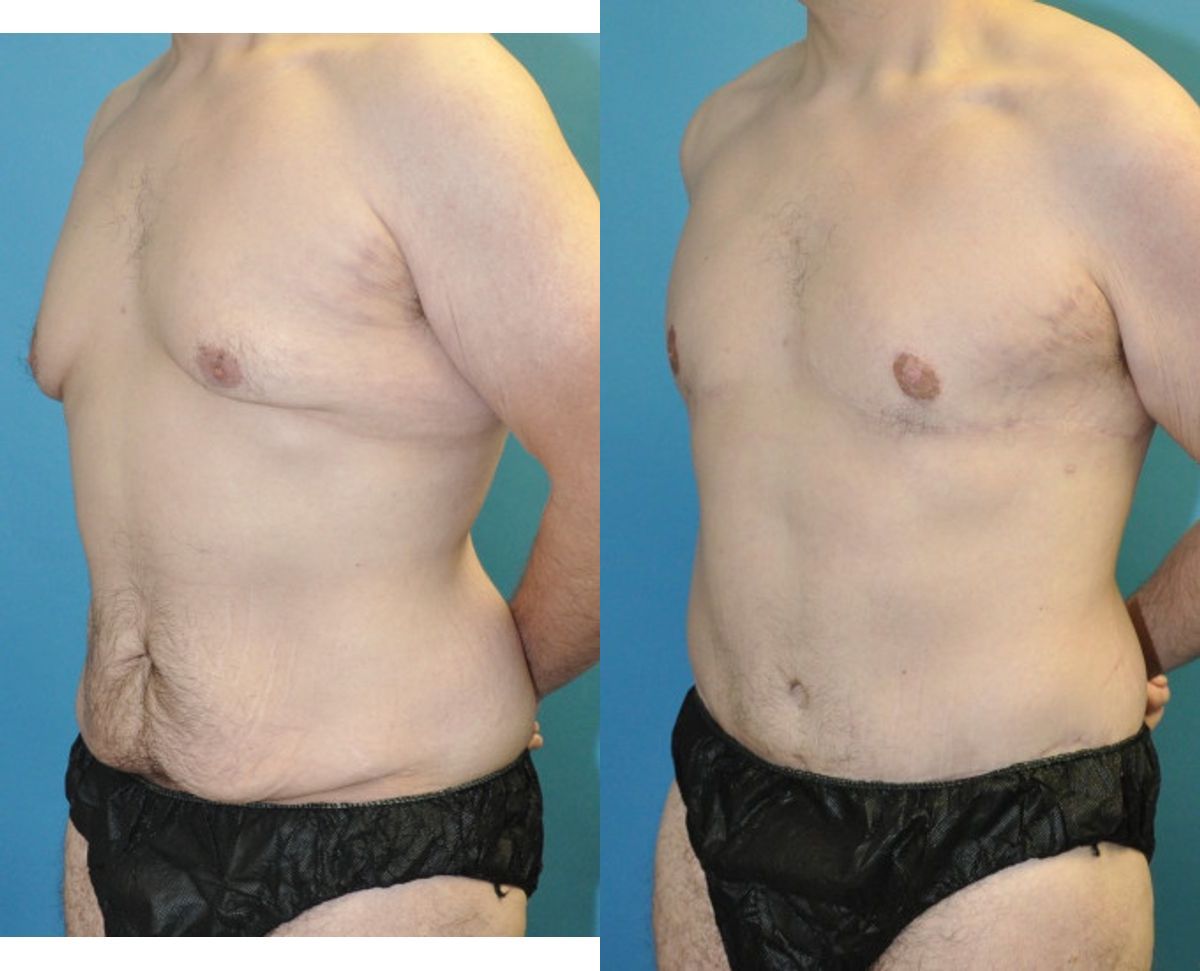 Total Body Lift (Upper and Lower Body Lift)#2 - Before and After