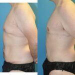 Total Body Lift (Upper and Lower Body Lift)#2 - Before and After
