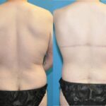 Total Body Lift (Upper and Lower Body Lift)#2 - Before and After