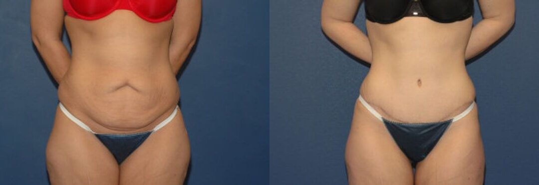 Tummy Tuck #1