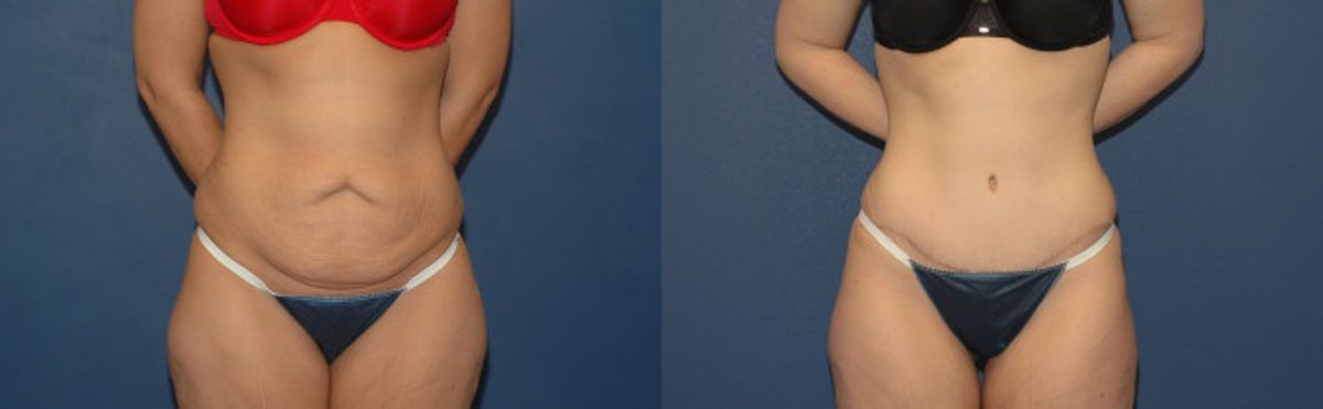 Tummy Tuck #1 - Before and After