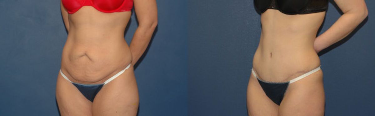 Tummy Tuck #1 - Before and After