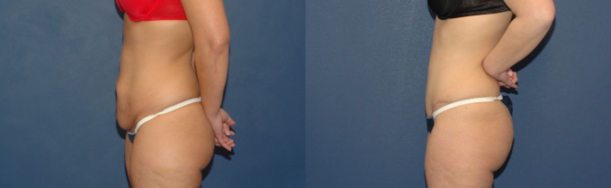 Tummy Tuck #1 - Before and After