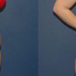 Tummy Tuck #1 - Before and After