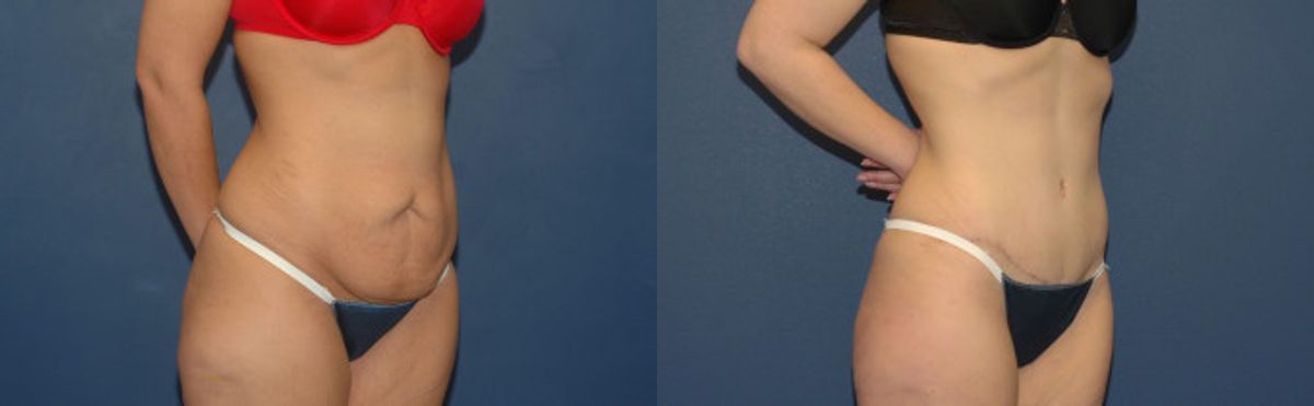 Tummy Tuck #1 - Before and After