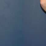 Tummy Tuck #1 - Before and After