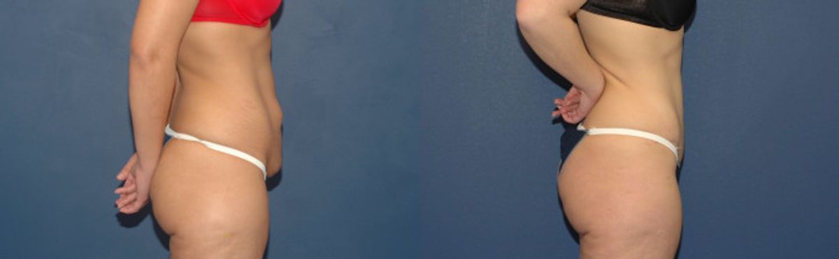 Tummy Tuck #1 - Before and After