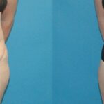 Tummy Tuck #2 - Before and After