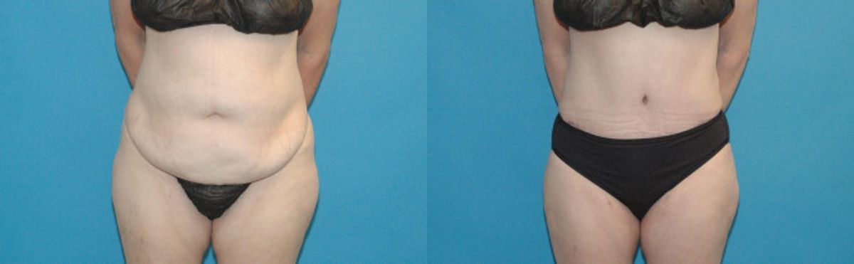 Tummy Tuck #2 - Before and After