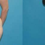 Tummy Tuck #2 - Before and After