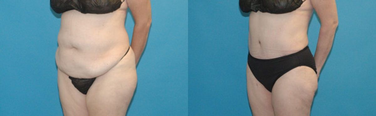 Tummy Tuck #2 - Before and After
