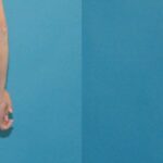 Tummy Tuck #2 - Before and After