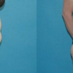 Tummy Tuck #2 - Before and After