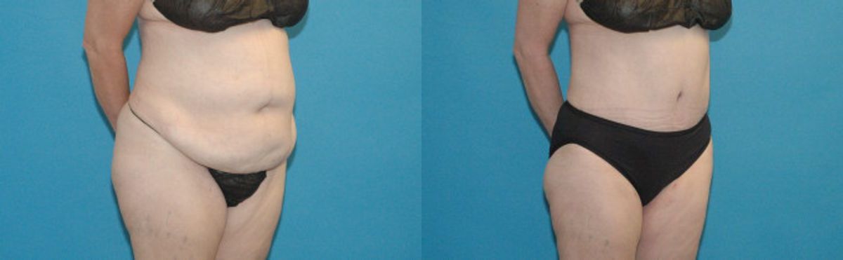 Tummy Tuck #2 - Before and After