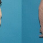 Tummy Tuck #2 - Before and After