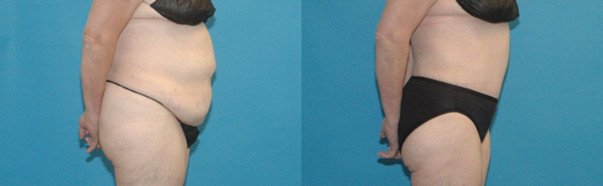 Tummy Tuck #2 - Before and After