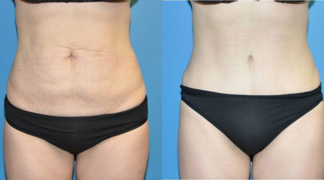 Tummy Tuck #3