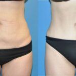 Tummy Tuck #3 - Before and After
