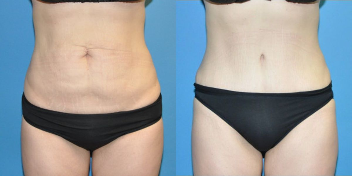 Tummy Tuck #3 - Before and After