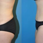 Tummy Tuck #3 - Before and After