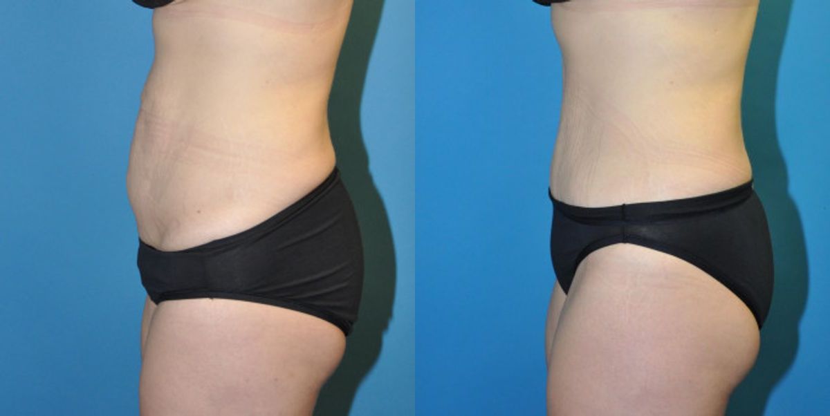 Tummy Tuck #3 - Before and After