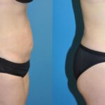 Tummy Tuck #3 - Before and After