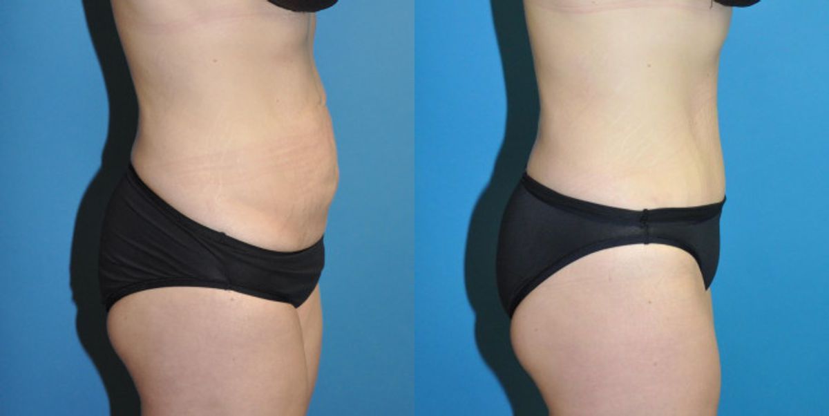 Tummy Tuck #3 - Before and After