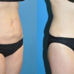 Tummy Tuck #3 - Before and After