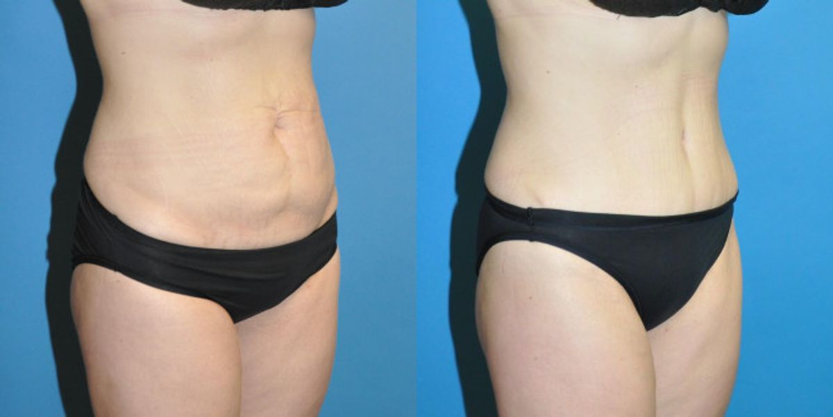 Tummy Tuck #3 - Before and After
