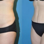 Tummy Tuck #3 - Before and After