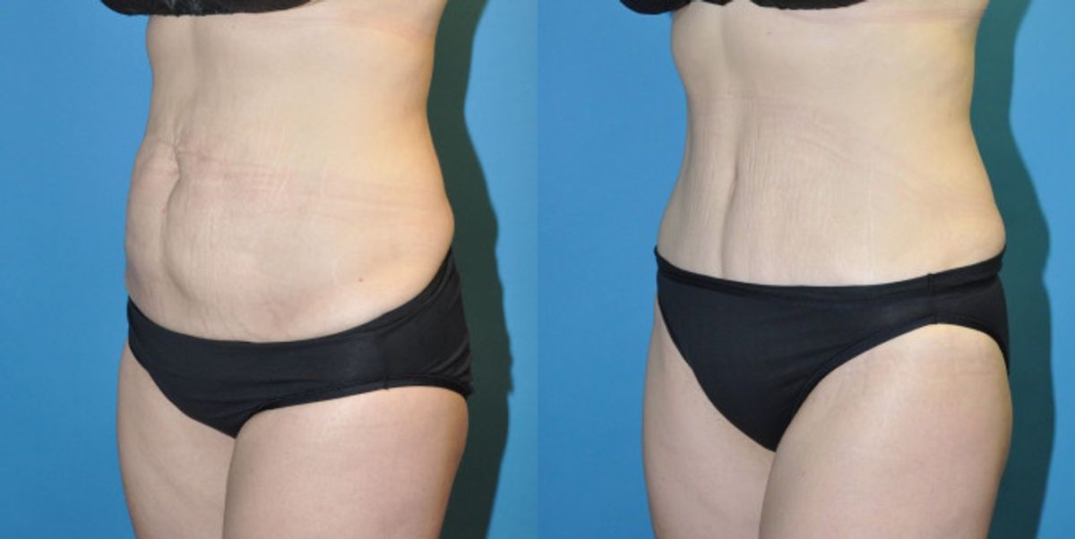 Tummy Tuck #3 - Before and After
