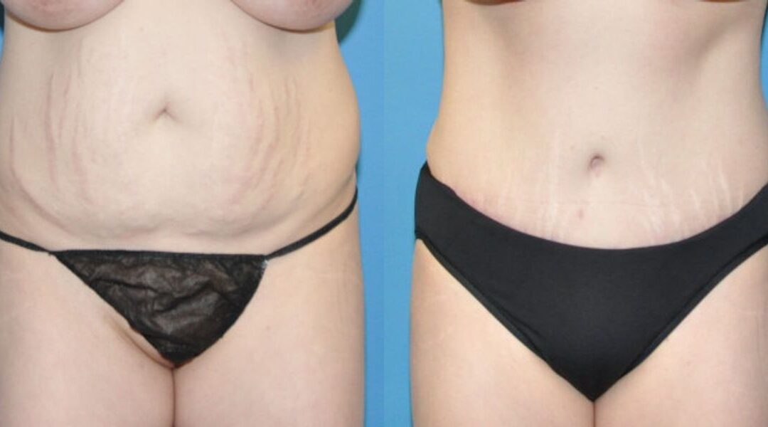 Tummy Tuck #4