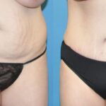 Tummy Tuck #4 - Before and After