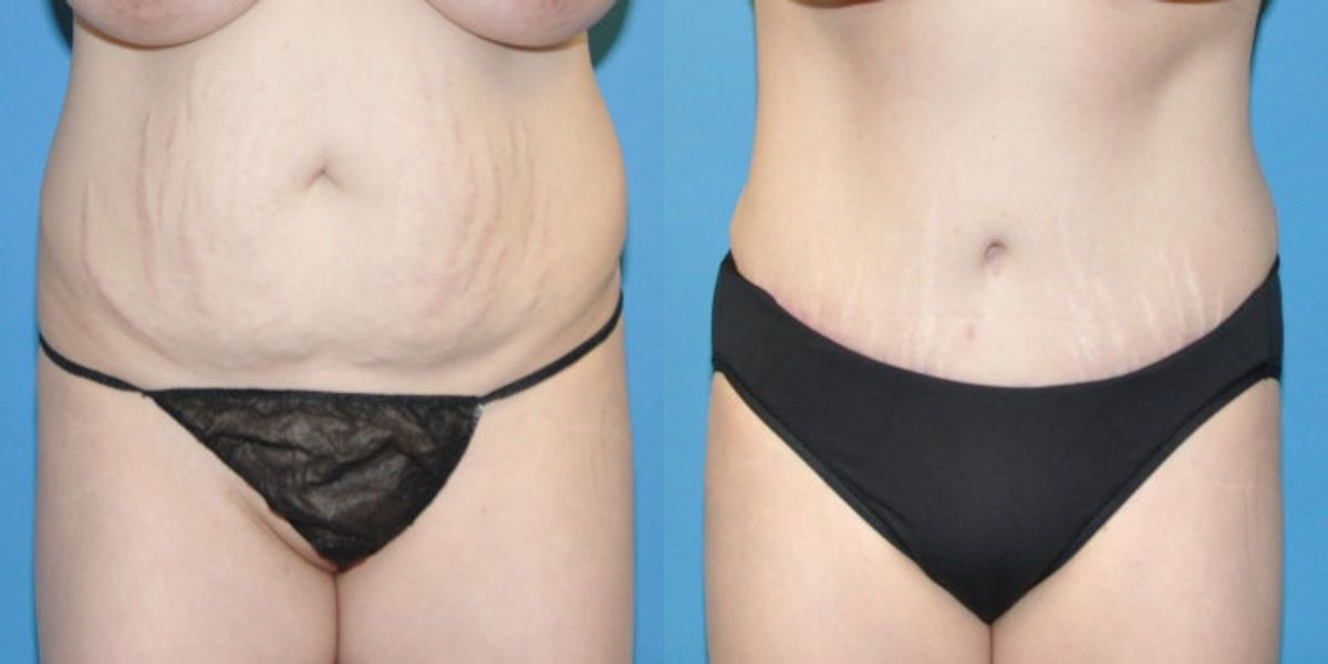 Tummy Tuck #4 - Before and After