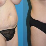 Tummy Tuck #4 - Before and After