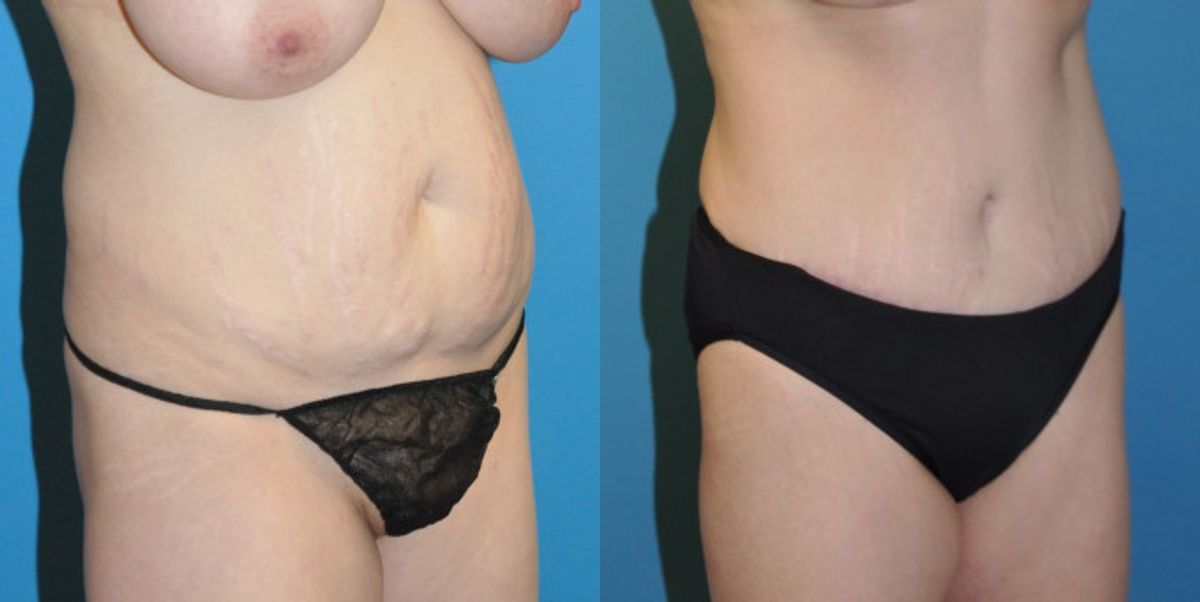 Tummy Tuck #4 - Before and After