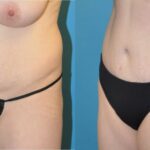 Tummy Tuck #4 - Before and After