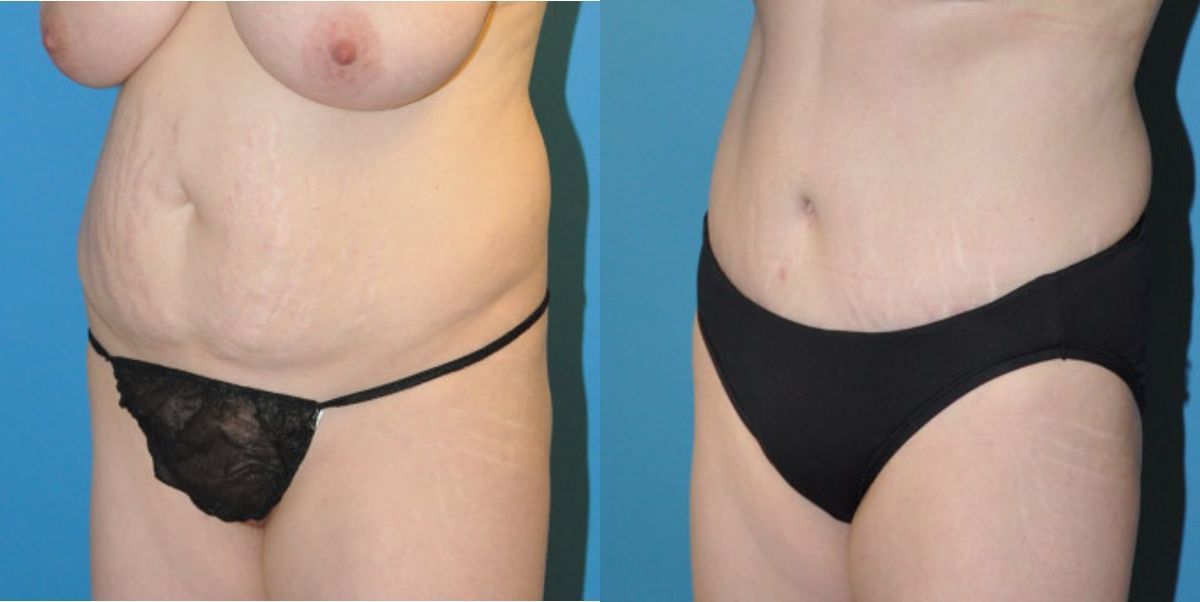 Tummy Tuck #4 - Before and After