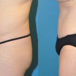 Tummy Tuck #4 - Before and After