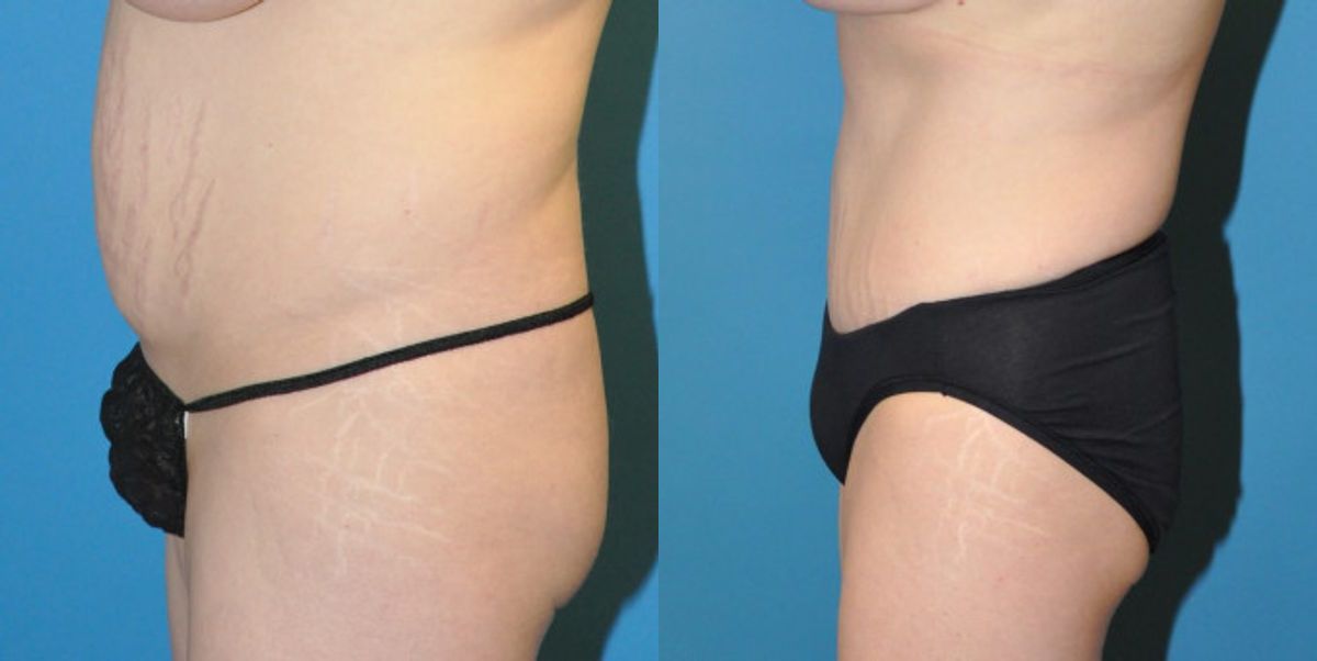 Tummy Tuck #4 - Before and After