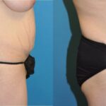 Tummy Tuck #4 - Before and After