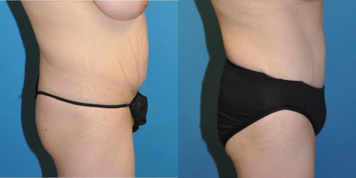 Tummy Tuck #4 - Before and After