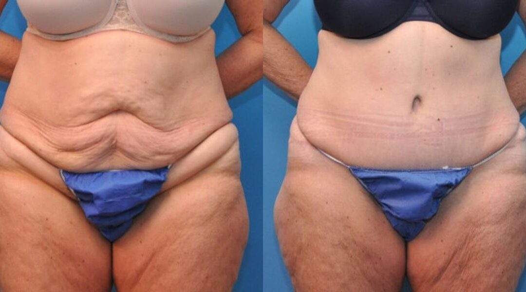 Tummy Tuck #5